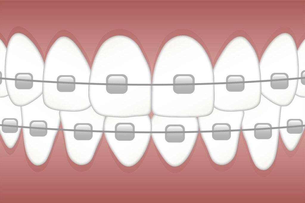 Gums and teeth with braces