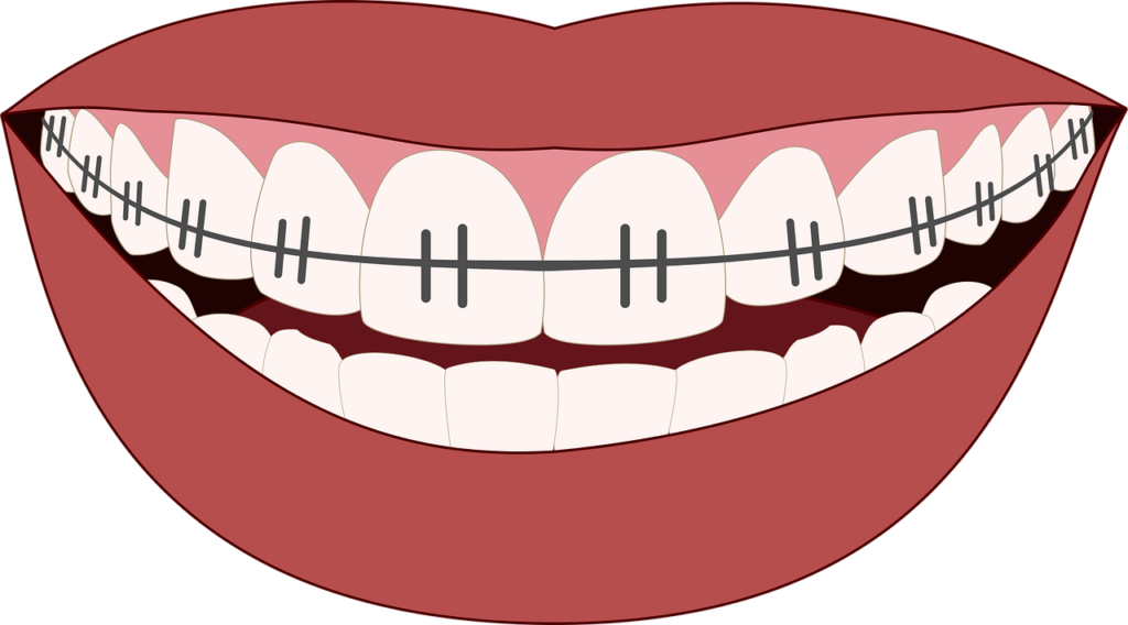 Picture of a mouth with braces