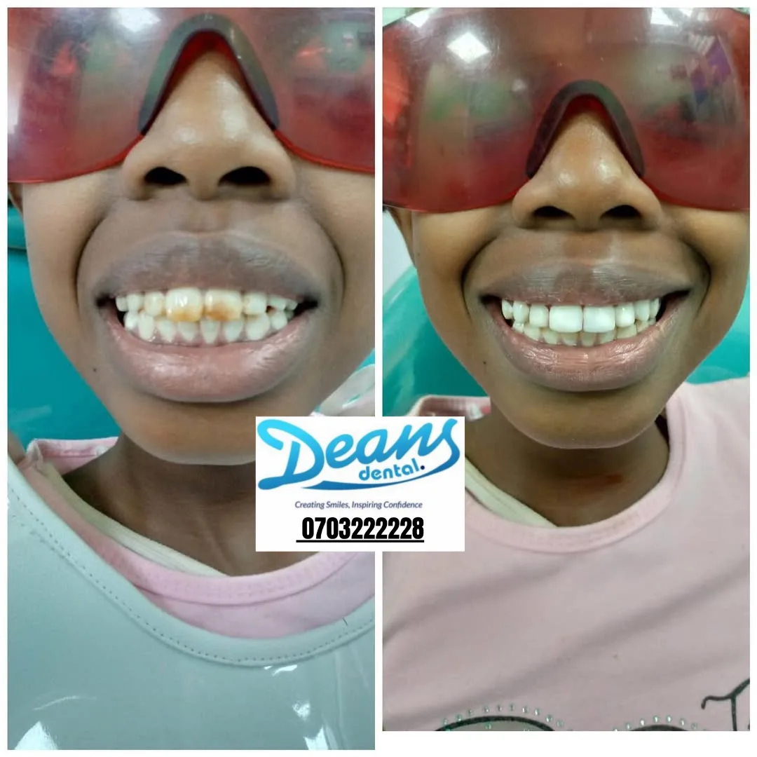 before and after teeth whitening results Nairobi