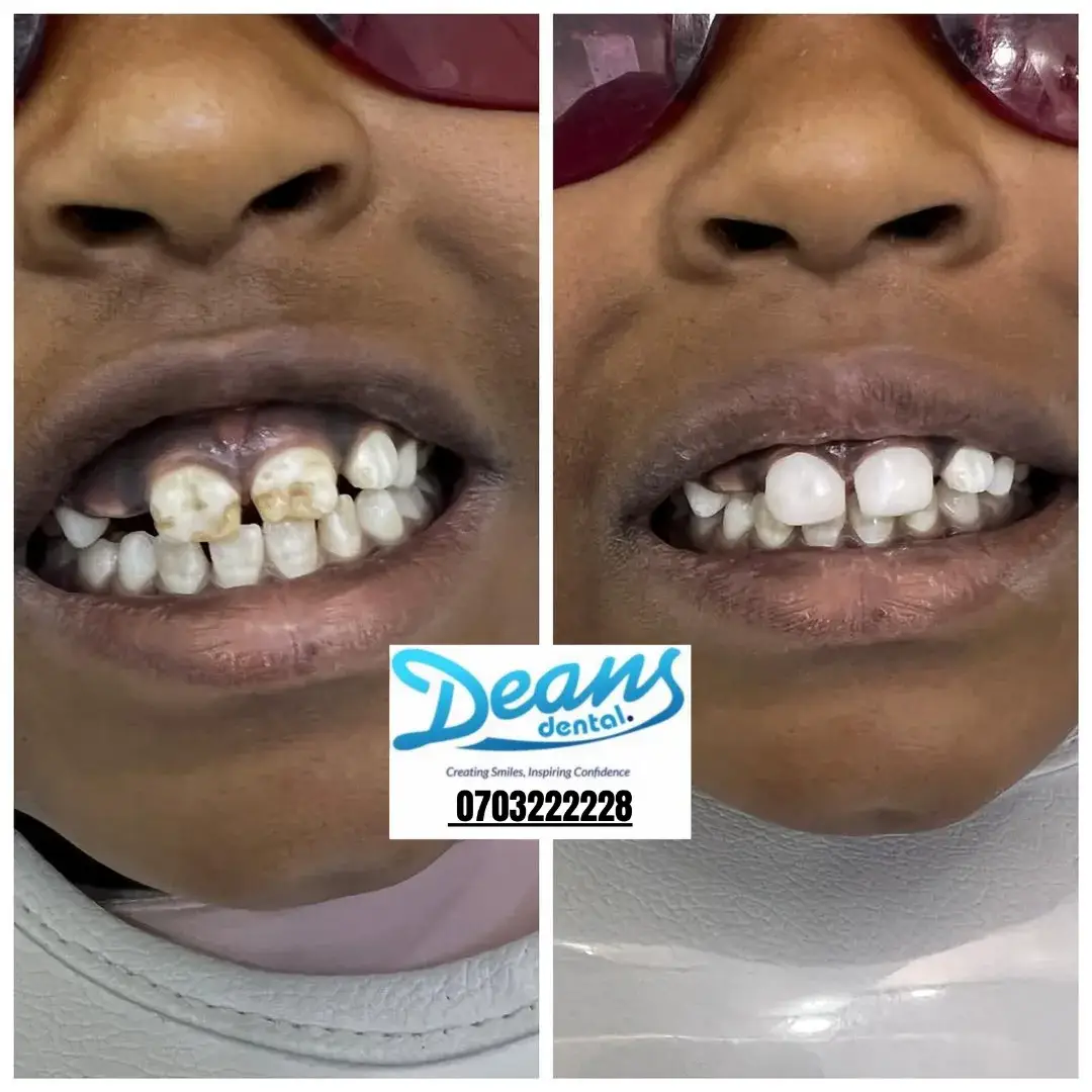 professional Teeth whitening before and after teeth whitening results Nairobi