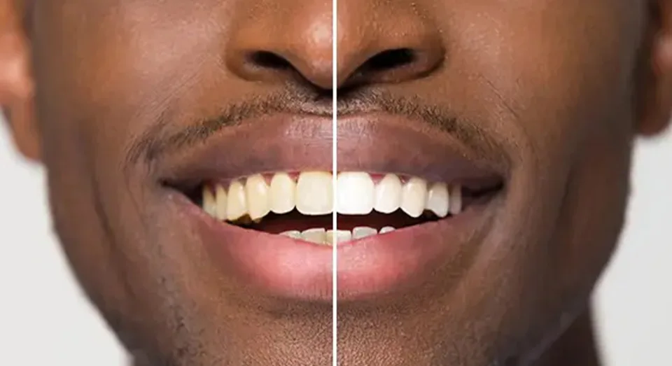 deans dental scaling and polishing Nairobi